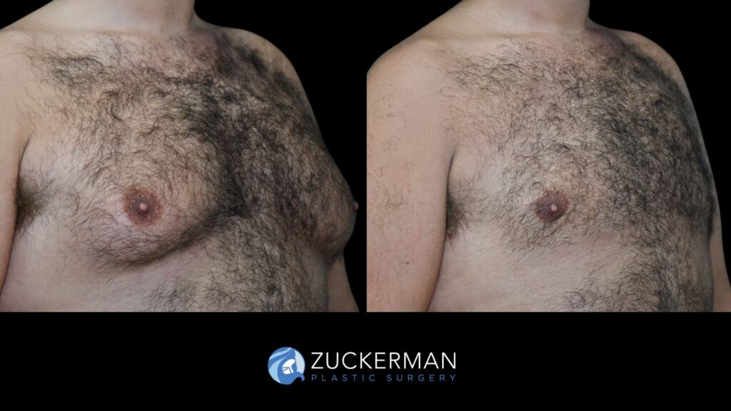 male patient before and after liposuction and renuvion to chest, right oblique view