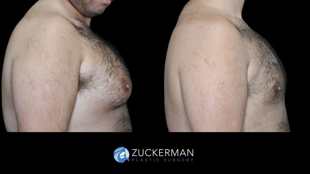 male patient before and after liposuction and renuvion to chest, right side view