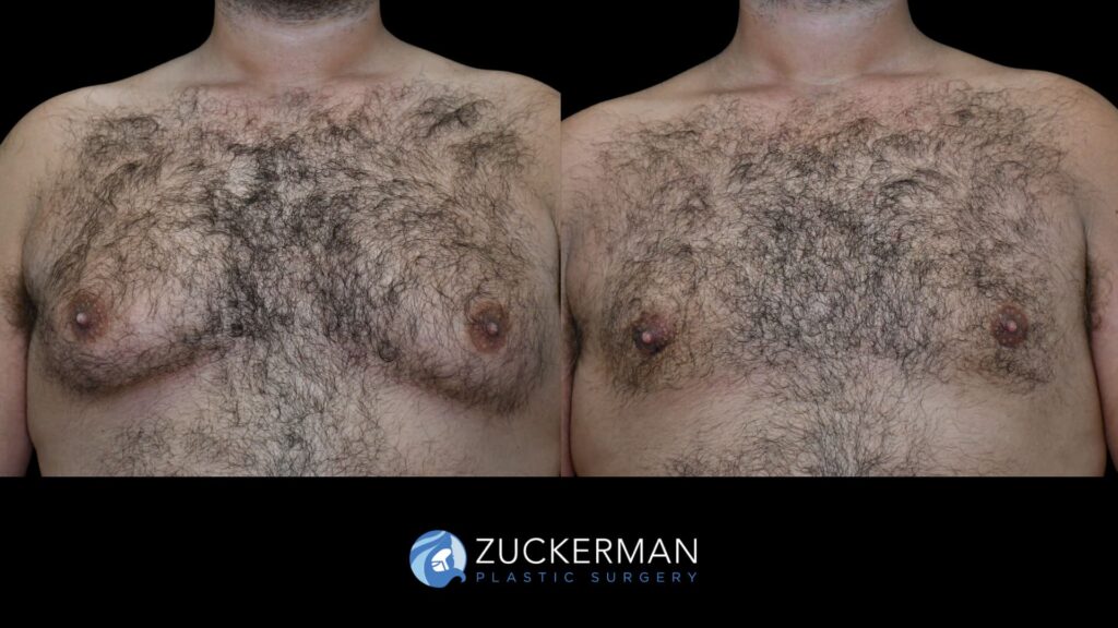 male patient before and after liposuction and renuvion to chest, front view