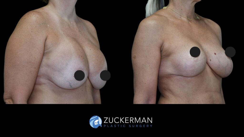 patient before and after implant exchange, right oblique view