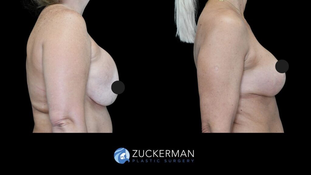 patient before and after implant exchange, right side view