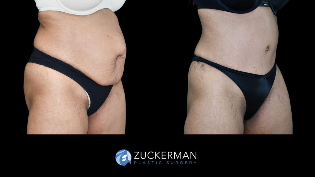 female patient before and after tummy tuck with lipo to flanks and hernia repair with mesh, right oblique view