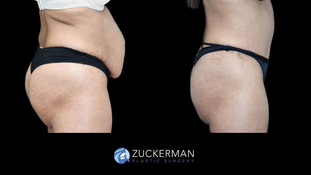 female patient before and after tummy tuck with lipo to flanks and hernia repair with mesh, right side view