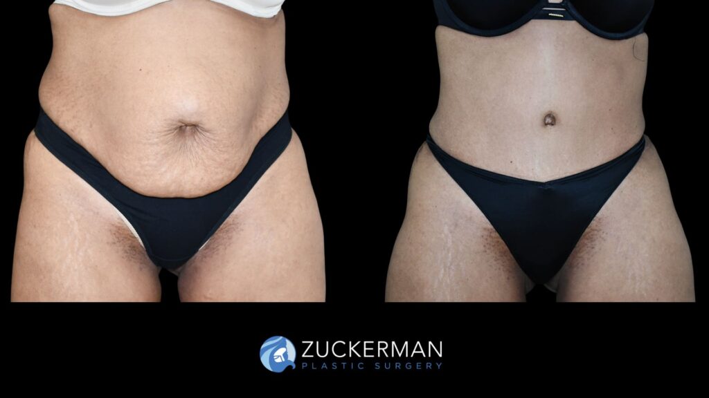 female patient before and after tummy tuck with lipo to flanks and hernia repair with mesh, front view