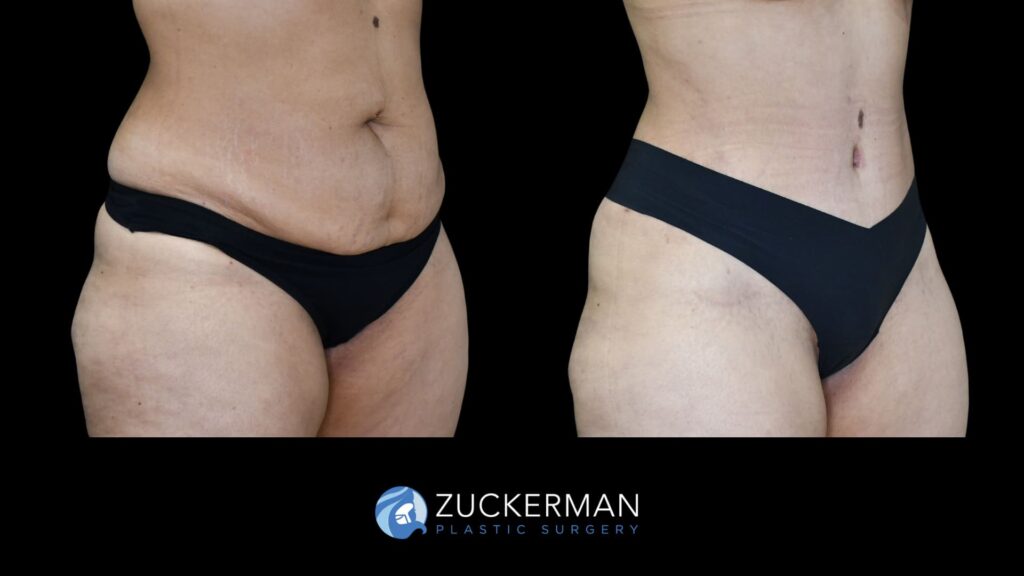 female patient before and after tummy tuck, right oblique view