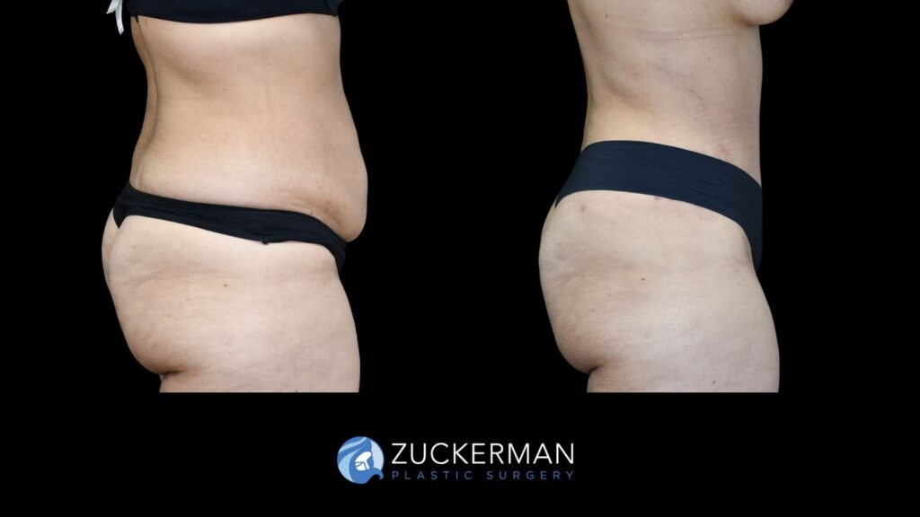 female patient before and after tummy tuck, right side view