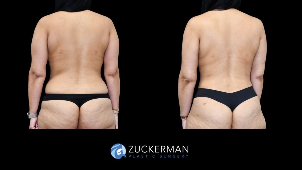 female patient before and after back liposuction