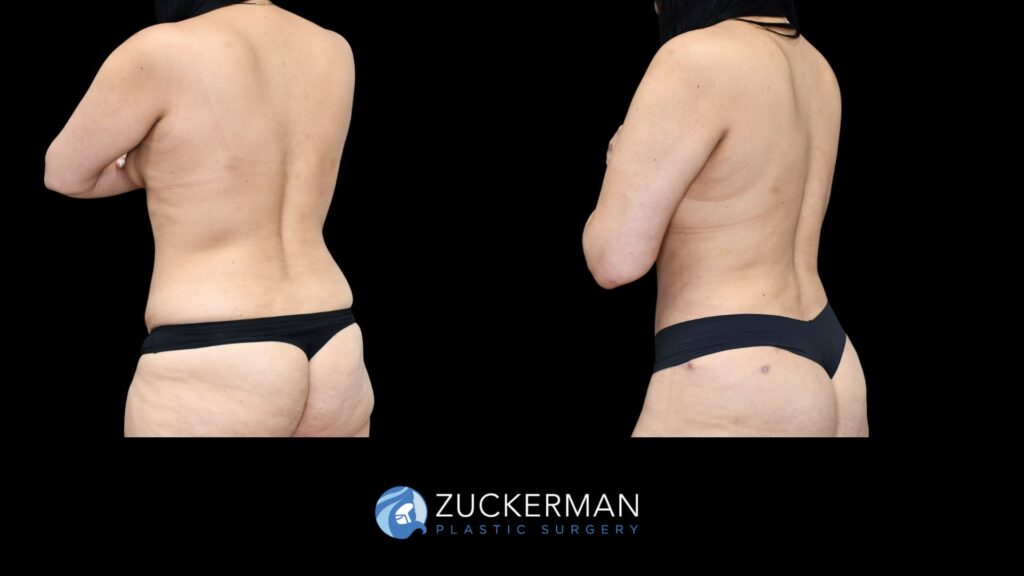 female patient before and after back liposuction