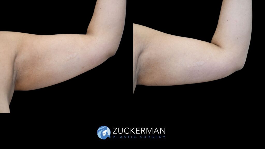 female patient before and after arm liposuction
