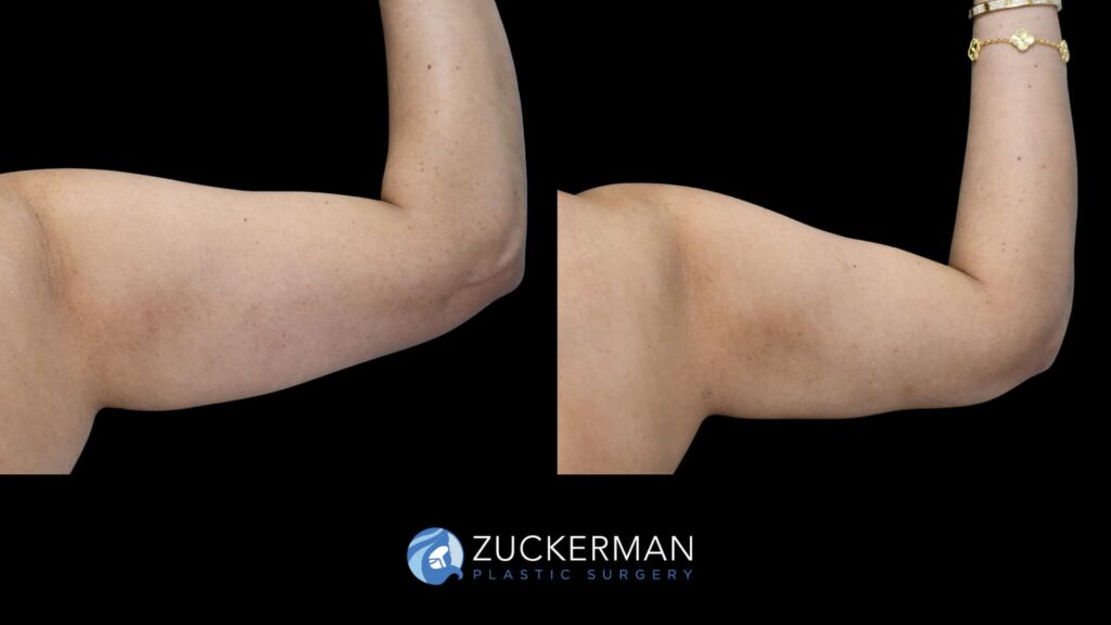 female patient before and after arm liposuction