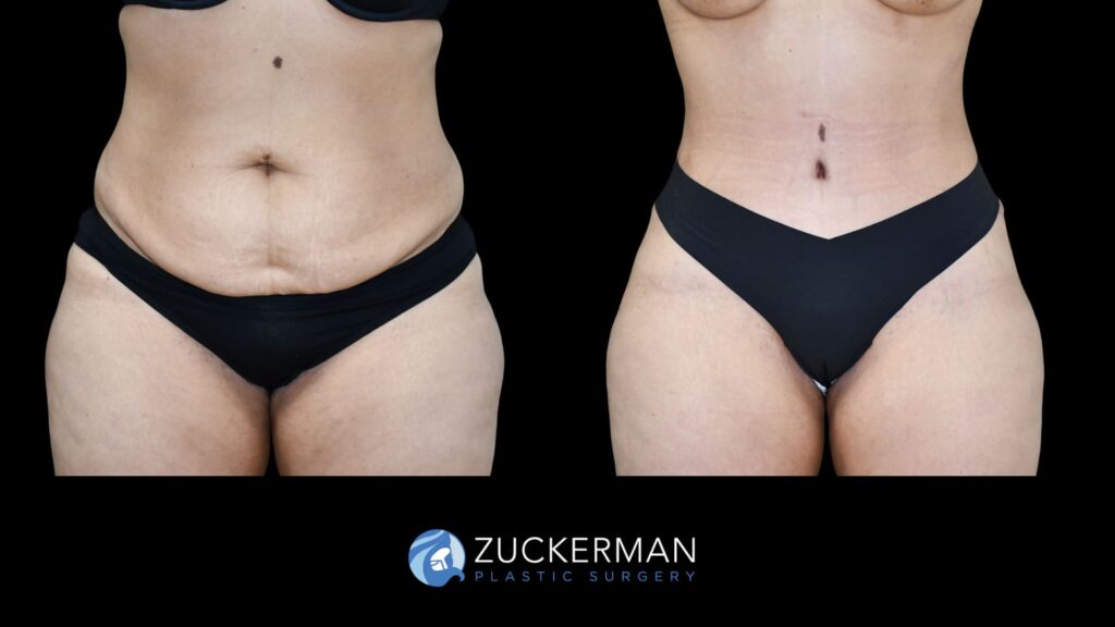 female patient before and after tummy tuck, front view