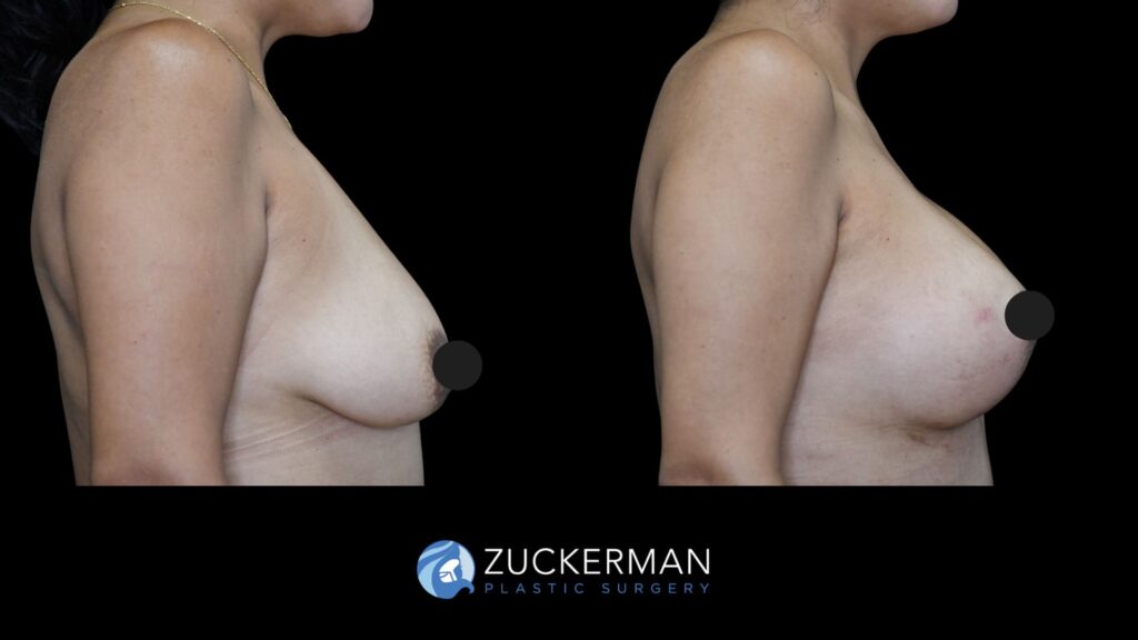 female patient before and after breast augmentation mastopexy, right side view