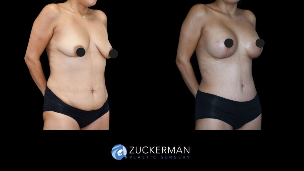 female patient before and after tummy tuck, back liposuction and augmentation mastopexy, right oblique view