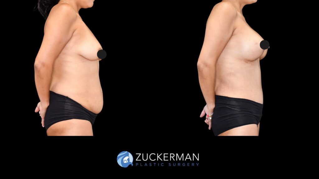 female patient before and after tummy tuck, back liposuction and augmentation mastopexy, right side view