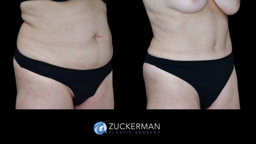 famel patient before and after tummy tuck, right oblique view