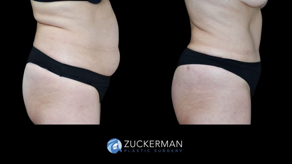 famel patient before and after tummy tuck, right side view