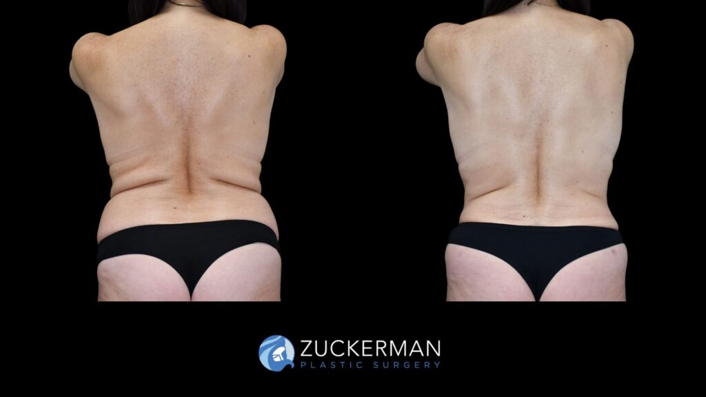 female patient before and after back liposuction