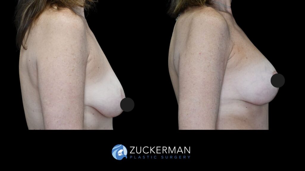 female patient before and after mastopexy, right side view