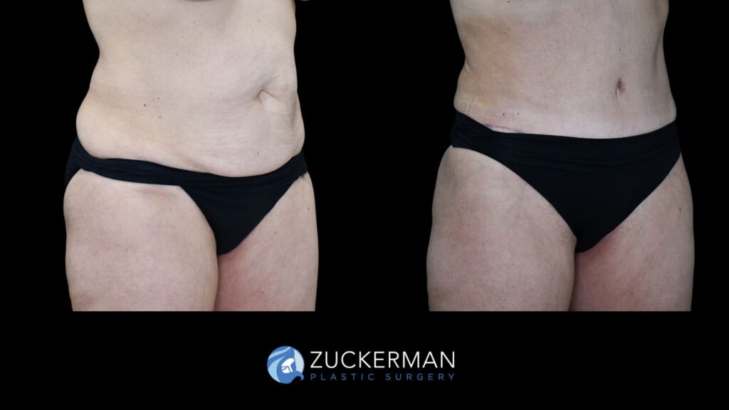 female patient before and after tummy tuck, right oblique view