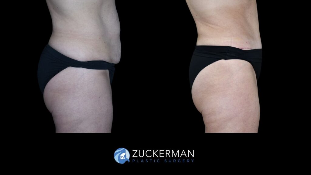 female patient before and after tummy tuck, right side view