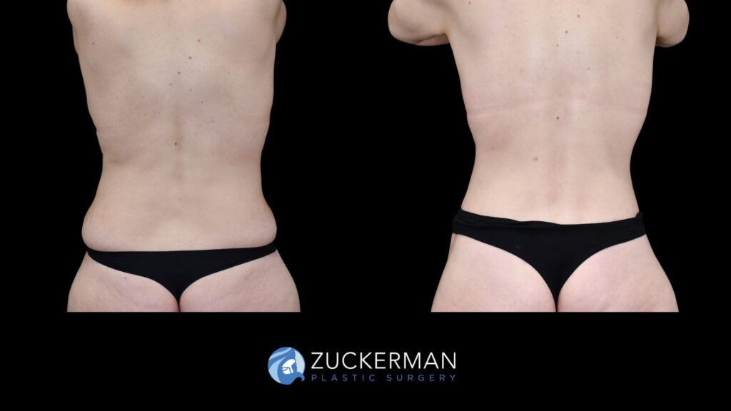 58. facelift, circumferential, breasts (10) license confirmed