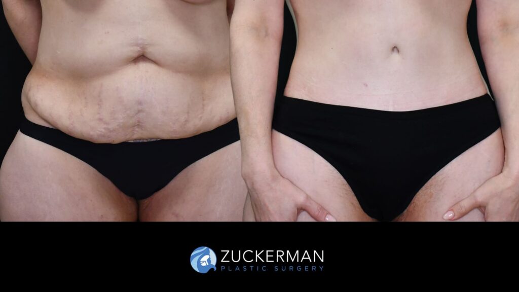58. facelift, circumferential, breasts (11) license confirmed
