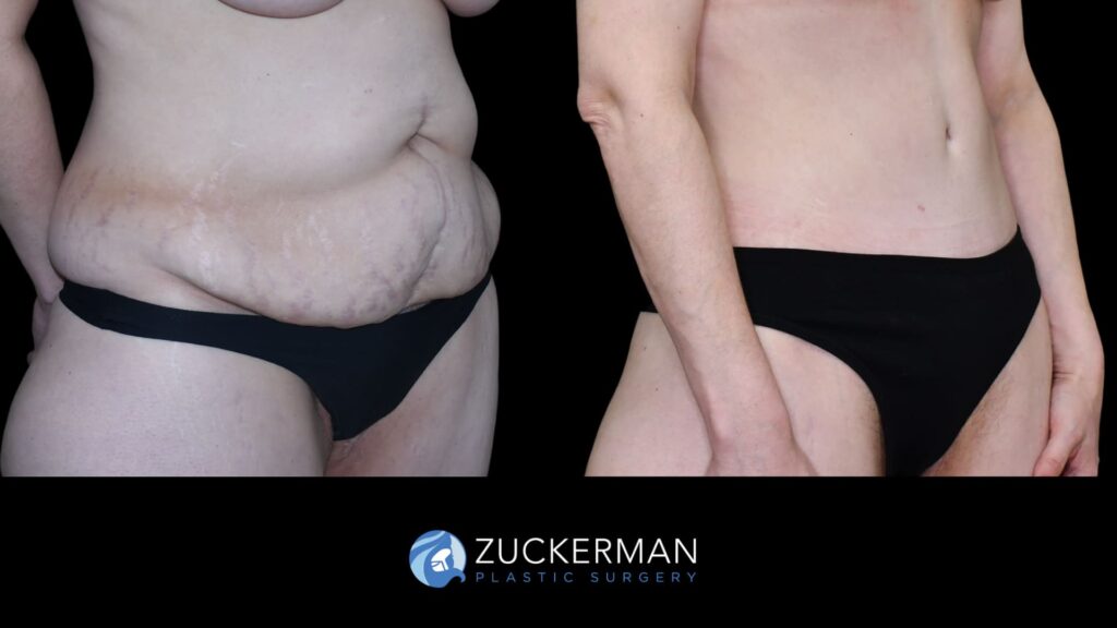 58. facelift, circumferential, breasts (12) license confirmed
