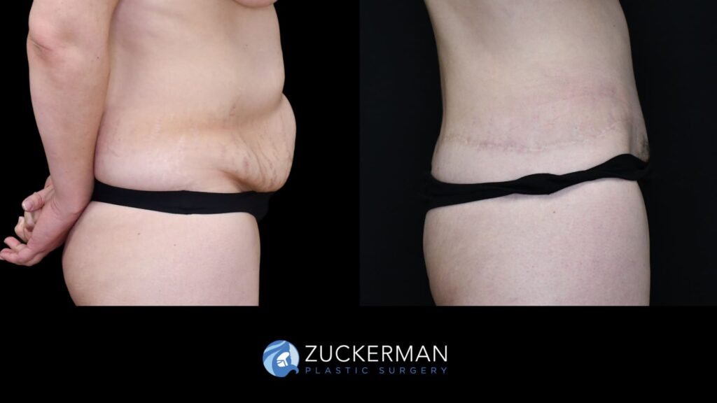 58. facelift, circumferential, breasts (13) license confirmed
