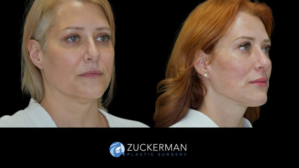 female patient before and after facelift, right oblique view