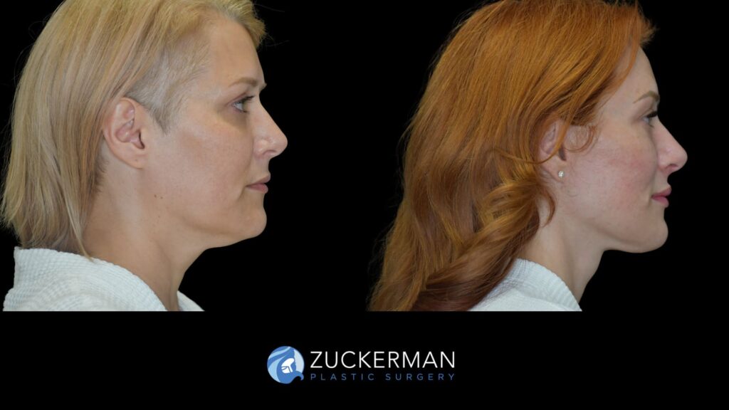 female patient before and after facelift, right side view
