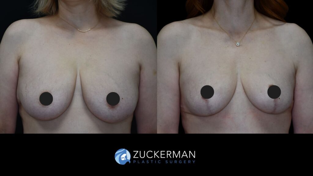 female patient before and after breast lift, front view