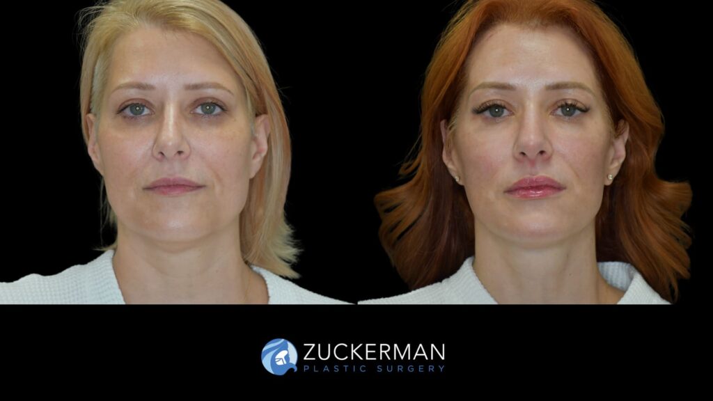 female patient before and after facelift, right oblique view